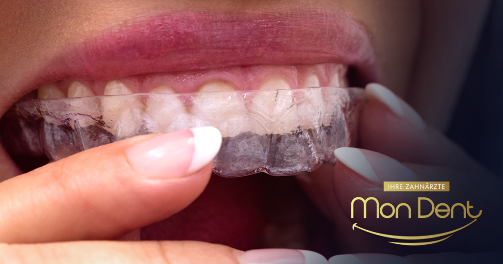 folije za ispravljanje zuba