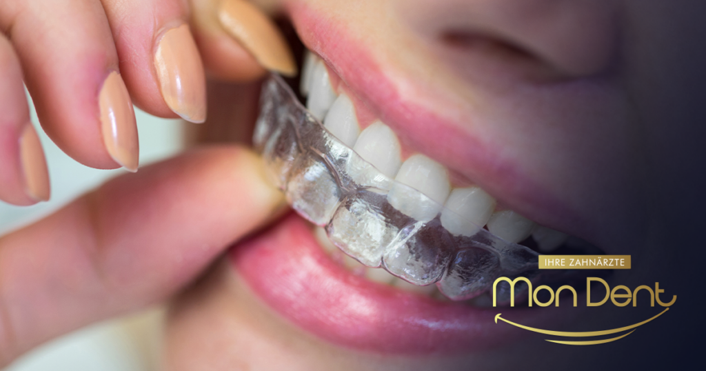 folije za ispravljanje zuba cijena