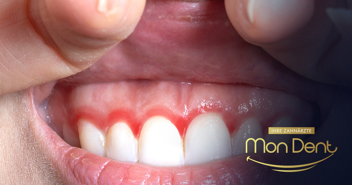 Upala desni nakon vađenja zuba ili ugradnje implantata – normalna reakcija ili komplikacija?