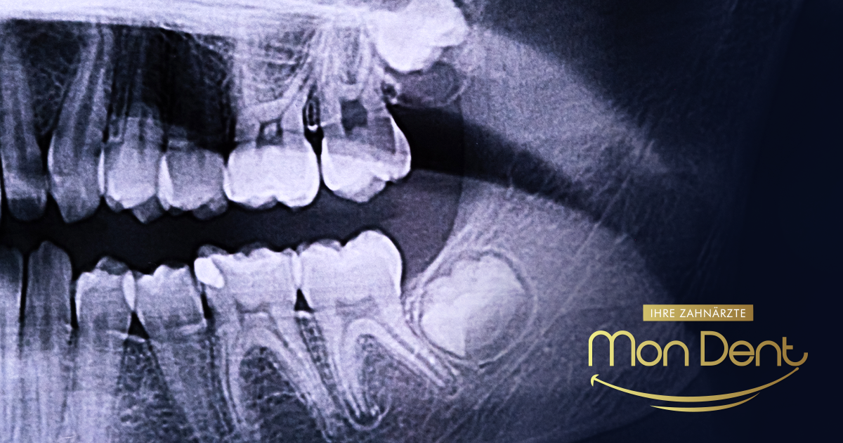 Kdaj je treba odstraniti modrostne zobe?
