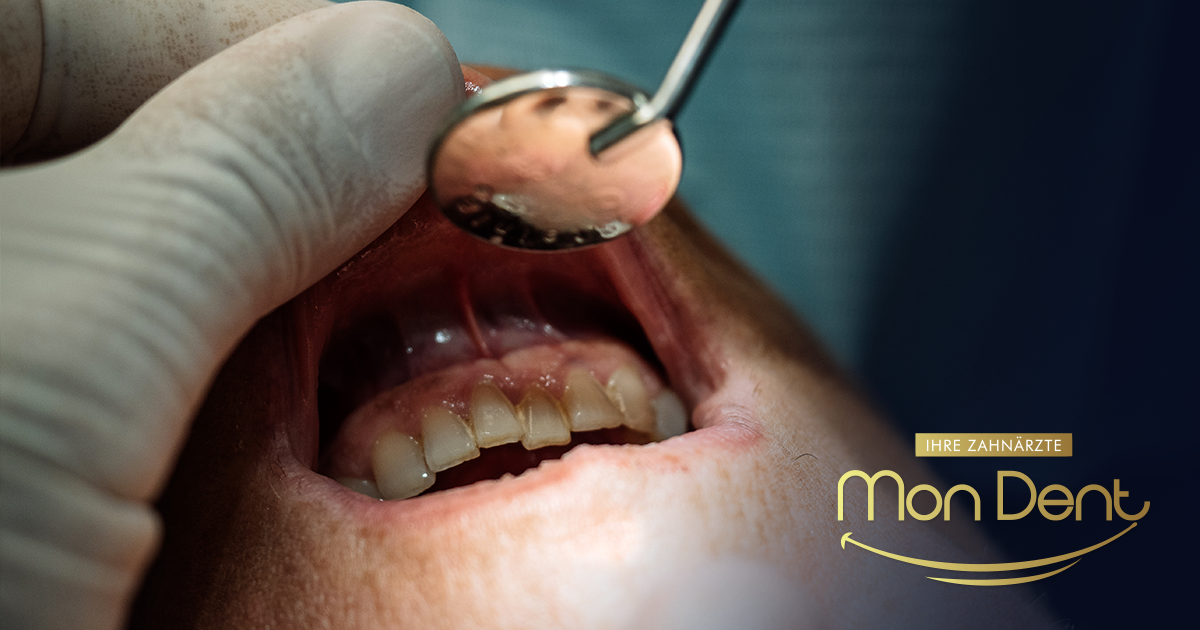 Parodontite e perdita dei denti: metodi moderni di trattamento e restauro