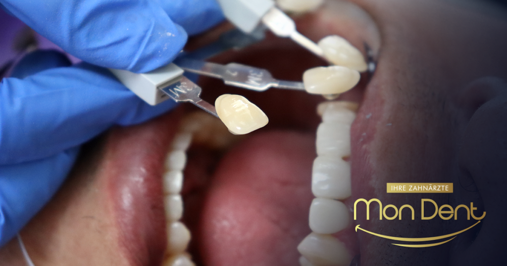Kompositveneers, Zahnklinik