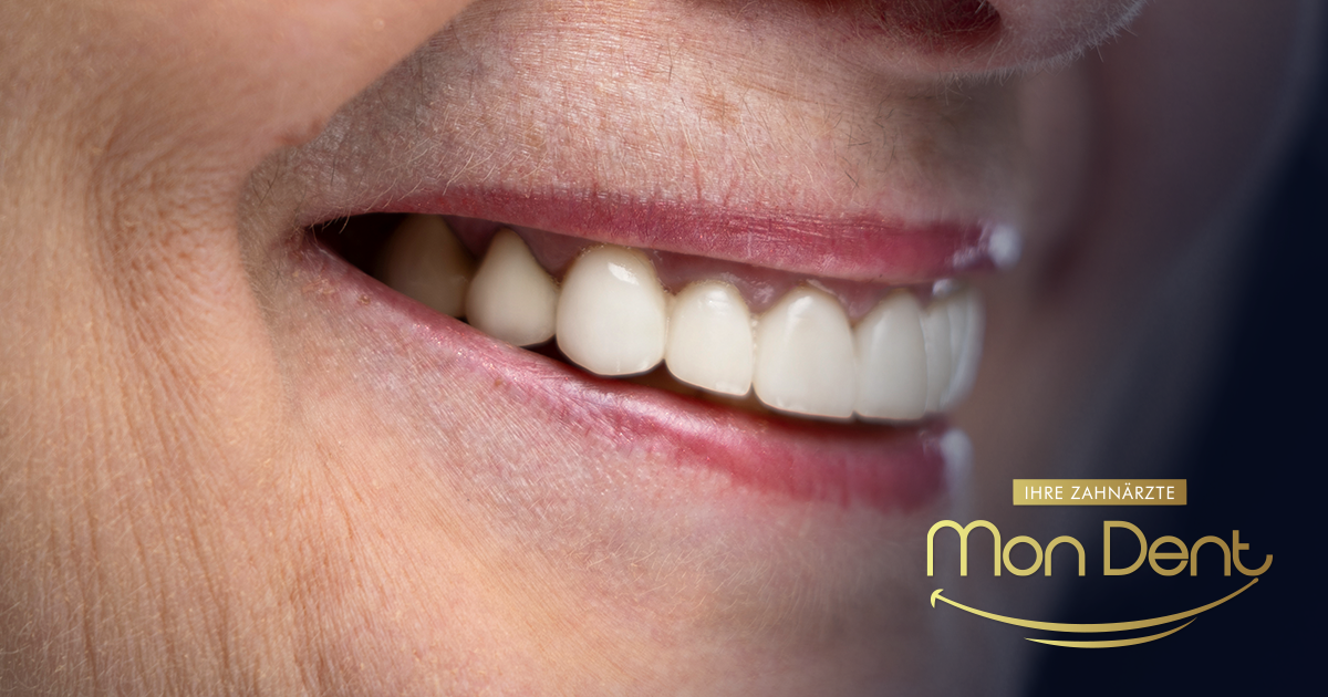 Inserimento di impianti dentali negli anziani