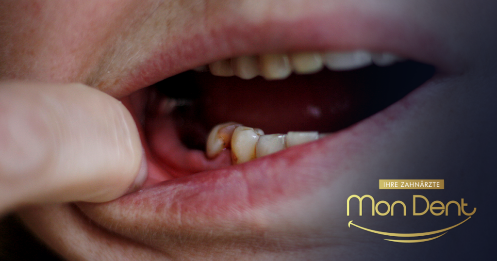 Zahngangrän, Zahnarztpraxis