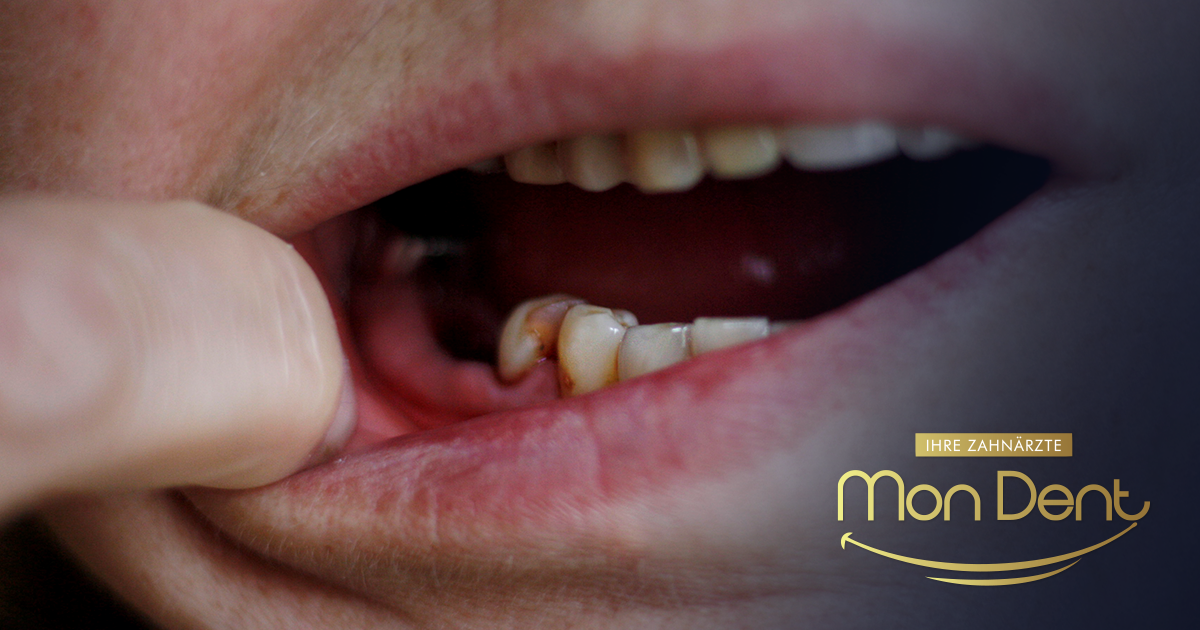 L'estrazione è l'unica cura per la cancrena dentale? Approcci moderni al trattamento in studio dentistico