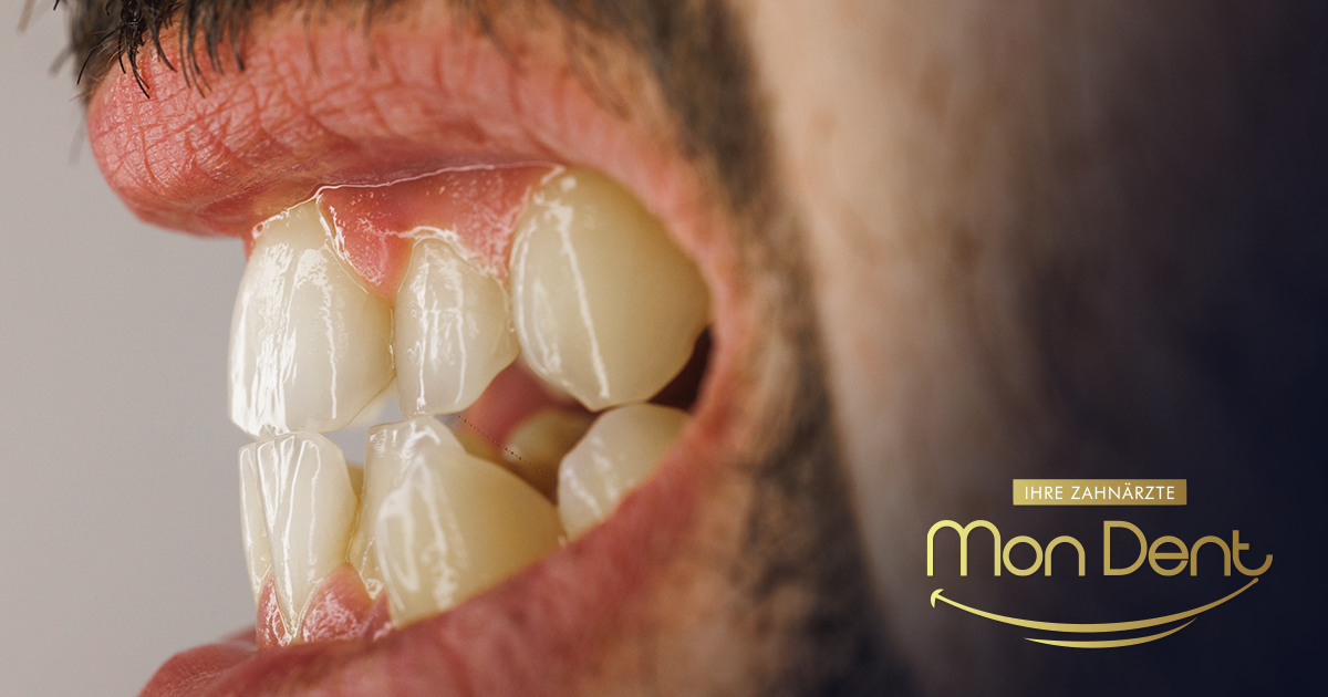 Budite se sa bolom u vilici? Evo kako spriječiti škripanje zubima u snu