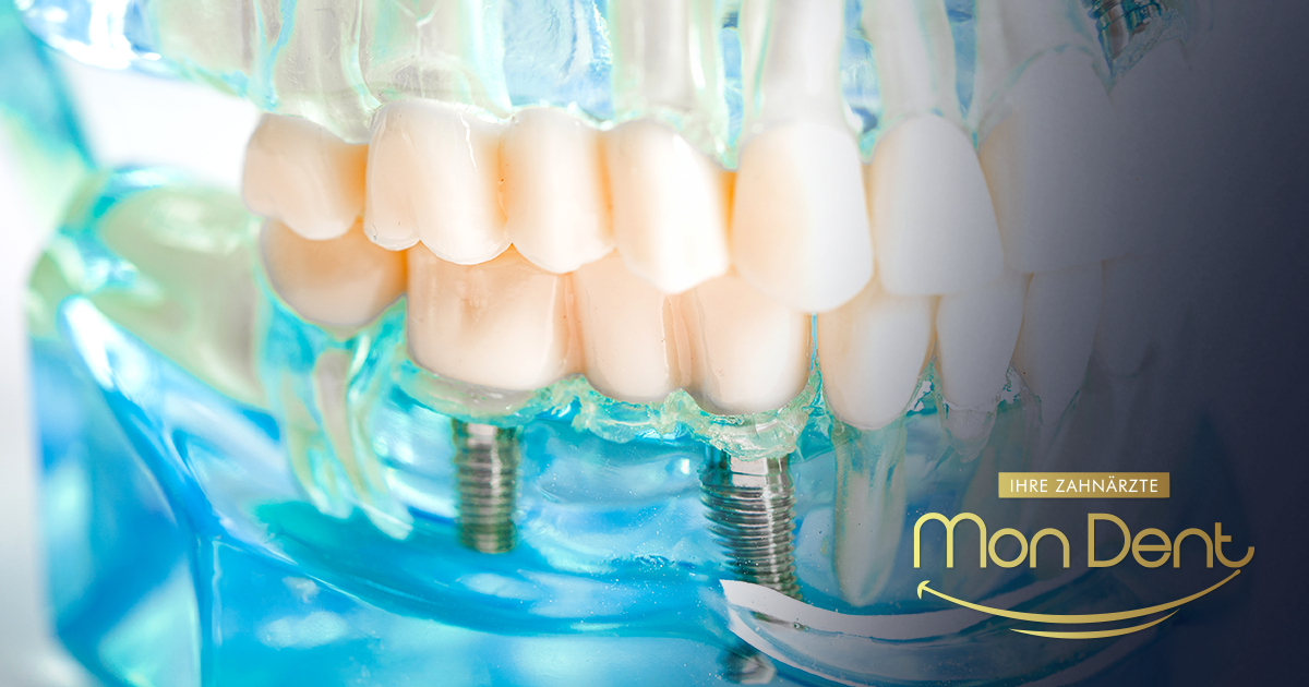 Spasite svoj osmijeh: Kako izgleda nadogradnja zuba i da li je bolna?