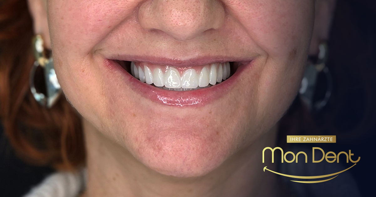 Razmišljate o All on 6 implantatima? Vodič kroz proceduru, oporavak i cijene u BiH