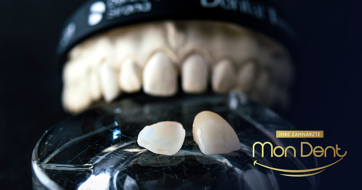 Da li su fasete za zube tajna savršenog osmijeha? Saznajte sve prednosti i mane