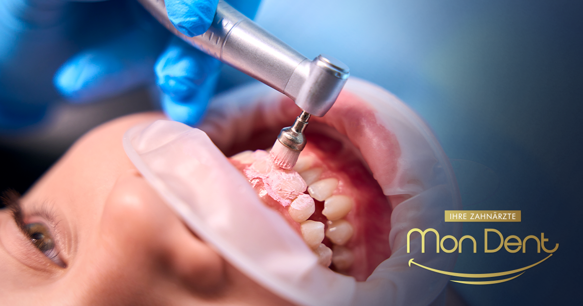 tartar removal, dental office, mondent