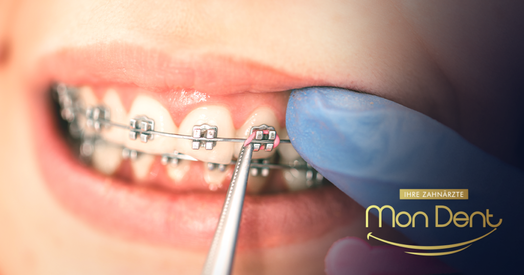 Festsitzende Zahnspangen, Mondent. Zahnarztpraxis, Kieferorthopädie.