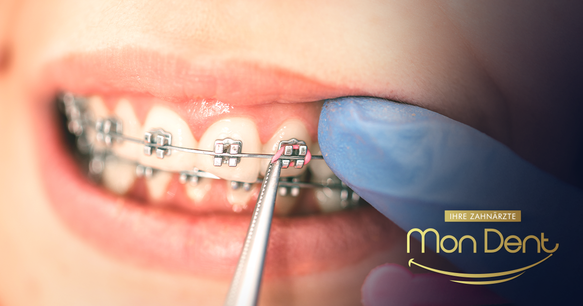 Pročitajte ovo prije odlaska ortodontu: Fiksni aparatić za zube i sve što vas zaista čeka