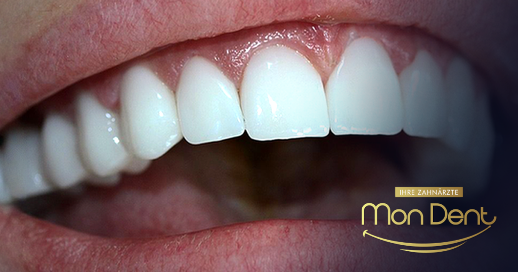 hollywood smile, stomatološka ordinacija, mondent