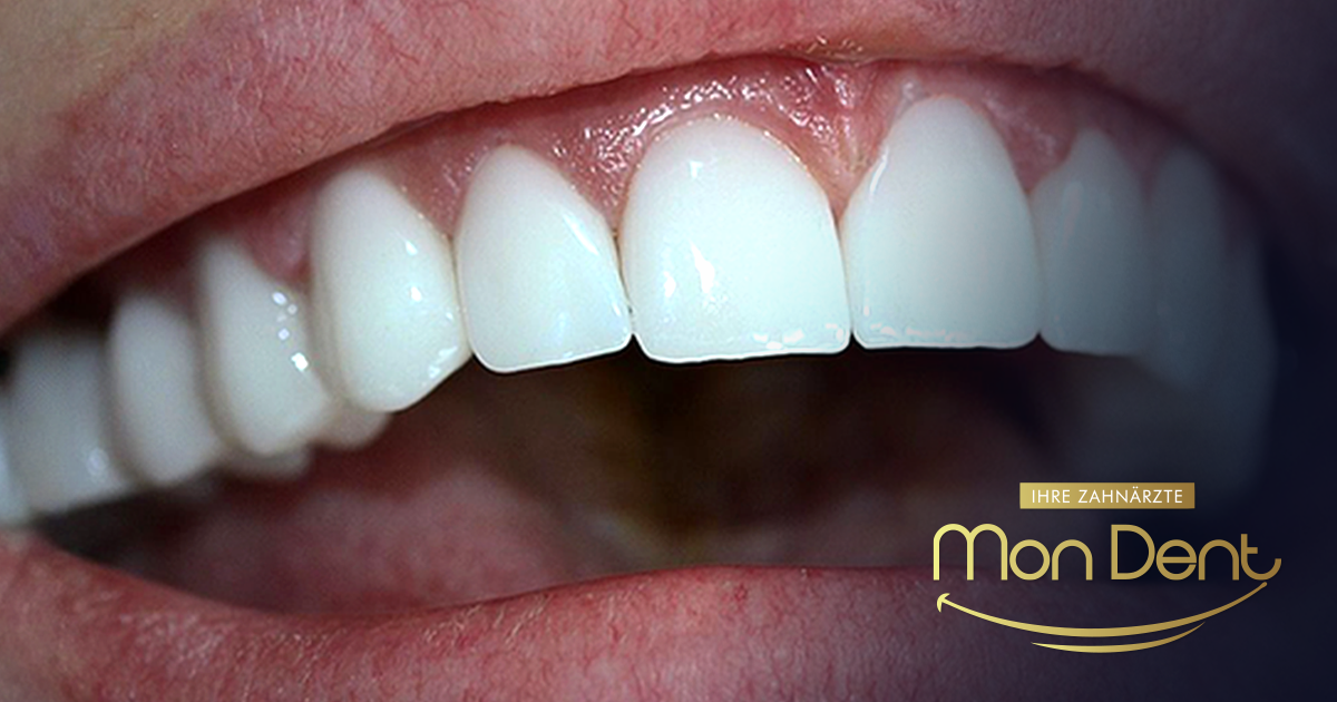 hollywood smile, stomatološka ordinacija, mondent