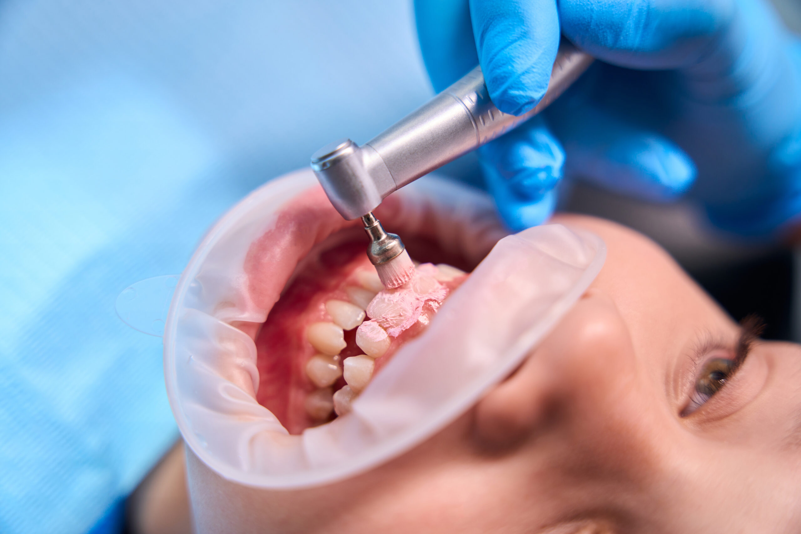 Zašto je čišćenje kamenca sa zuba najbolji izbor za ljubitelje kafe