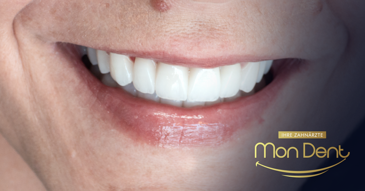 Corone dentali senza metallo a partire da 400 KM: cosa offre MonDent a questo prezzo?