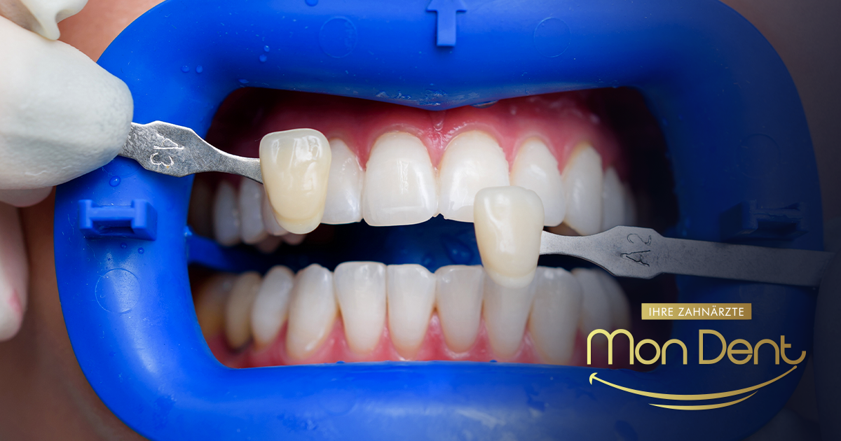 Faccette dall'aspetto naturale: come evitare un sorriso troppo bianco e artificiale?